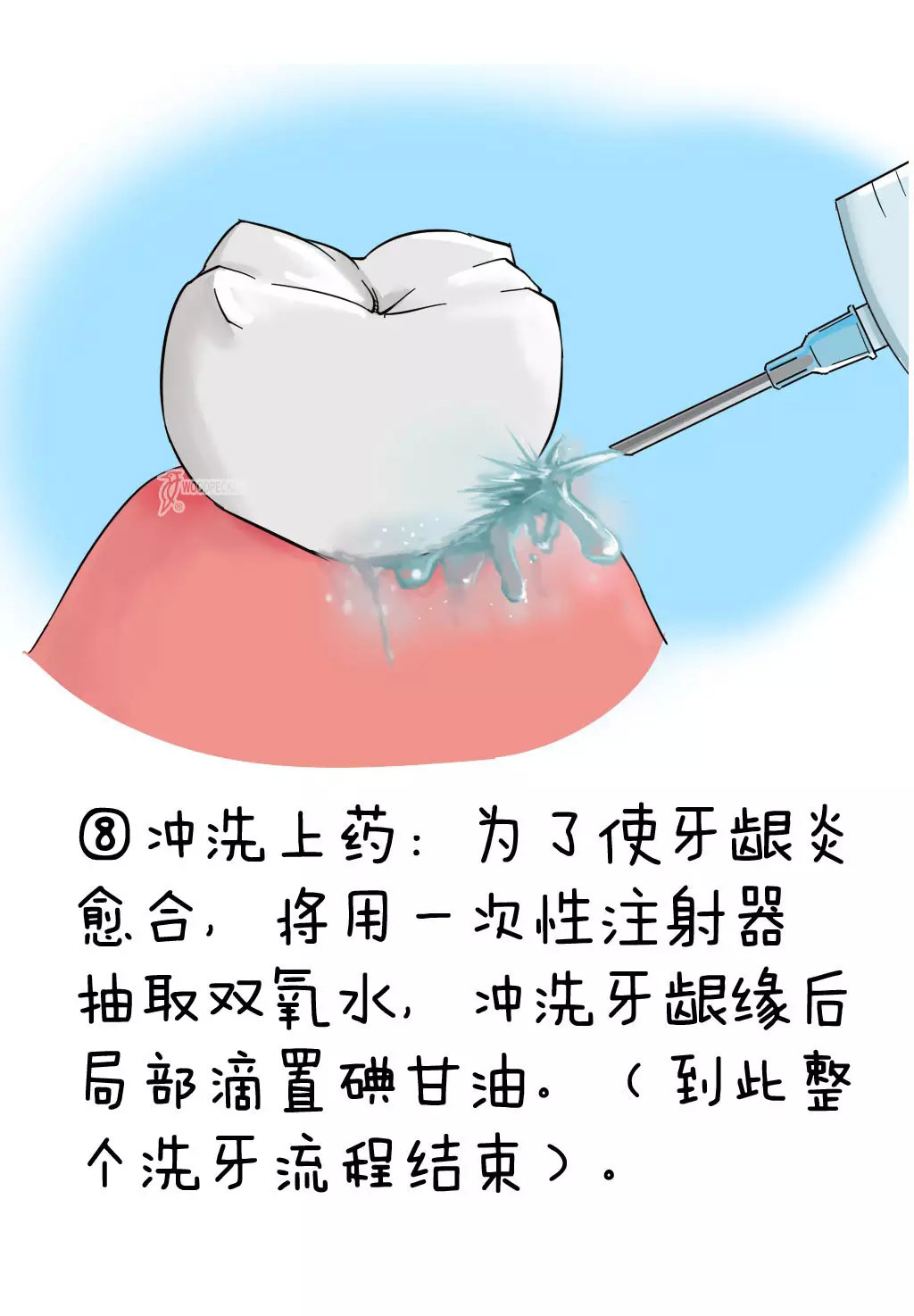 八、冲洗上药。为了帮助牙龈炎的愈合,我们将用一次性注射器抽取双氧水,冲洗牙龈缘后局部滴置碘甘油。到此整个洗牙流程结束。 八、冲洗上药。为了帮助牙龈炎的愈合,我们将用一次性注射器抽取双氧水,冲洗牙龈缘后局部滴置碘甘油。到此整个洗牙流程结束。
